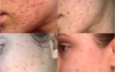 Curing Adult Acne After Antibiotics